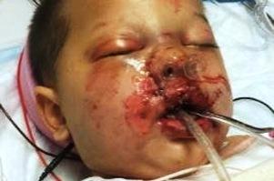 19-month-old Bounkham "Baby Bou Bou" Phonesavanh after a Georgia SWAT team threw a flash-bang grenade into his crib. (family)